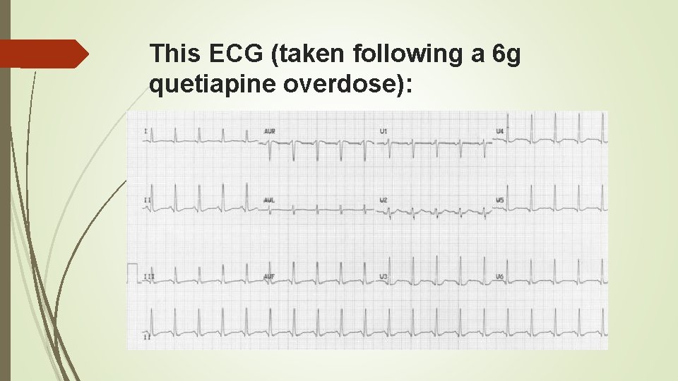 This ECG (taken following a 6 g quetiapine overdose): 