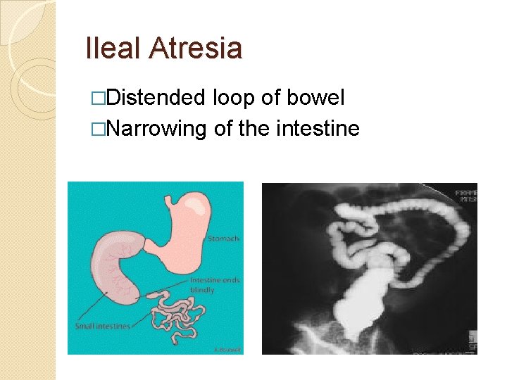 Ileal Atresia �Distended loop of bowel �Narrowing of the intestine 