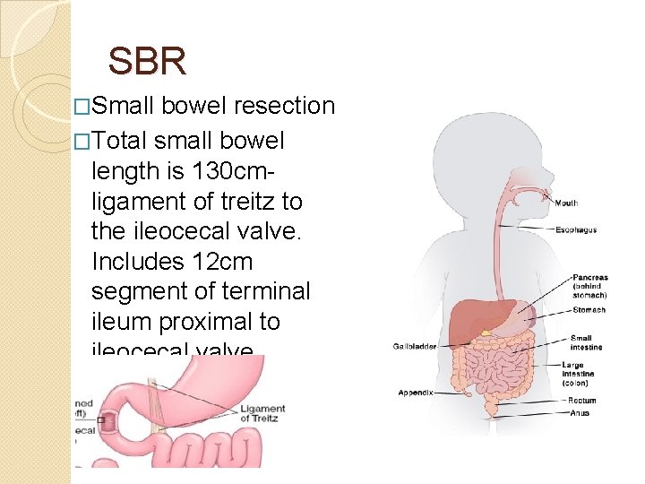 SBR �Small bowel resection �Total small bowel length is 130 cm- ligament of treitz