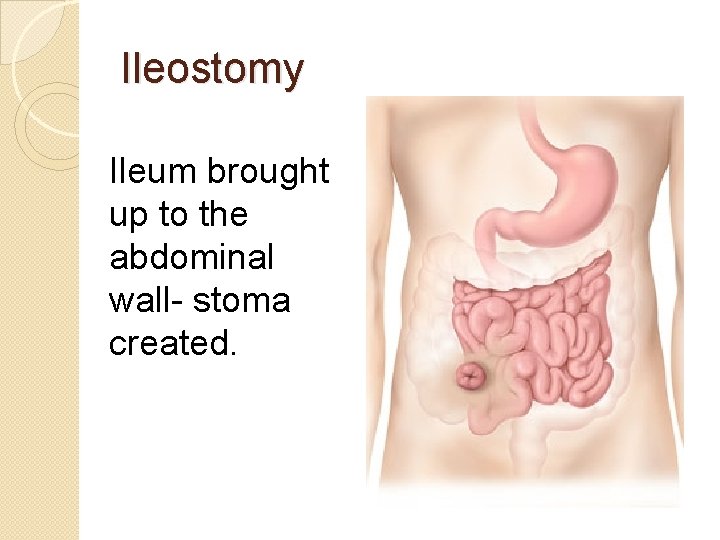 Ileostomy Ileum brought up to the abdominal wall- stoma created. 