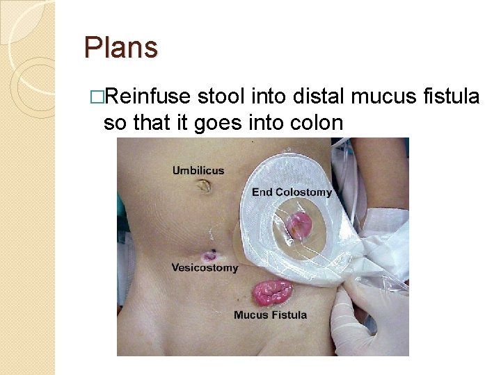 Plans �Reinfuse stool into distal mucus fistula so that it goes into colon 