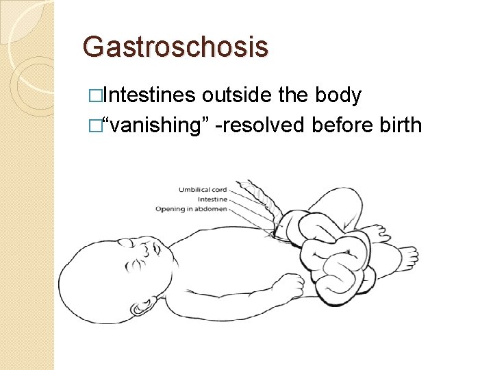 Gastroschosis �Intestines outside the body �“vanishing” -resolved before birth 