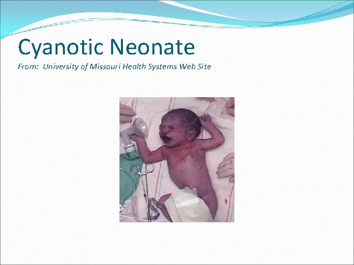 Cyanotic Neonate From: University of Missouri Health Systems Web Site 