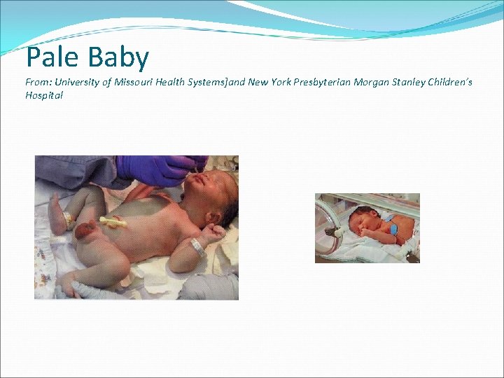 Pale Baby From: University of Missouri Health Systems]and New York Presbyterian Morgan Stanley Children’s