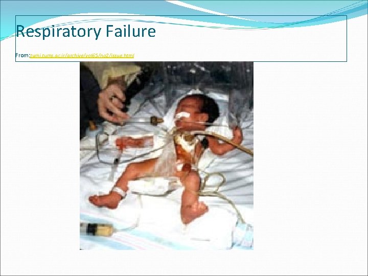 Respiratory Failure From: tumj. tums. ac. ir/archive/vol 65/no 2/issue. html 