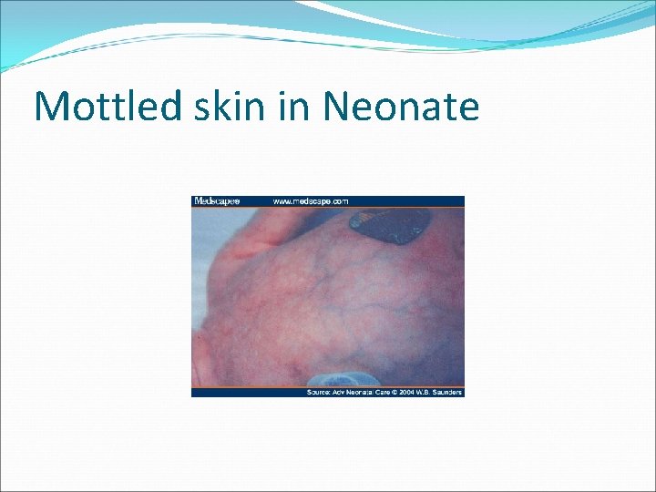 Mottled skin in Neonate 