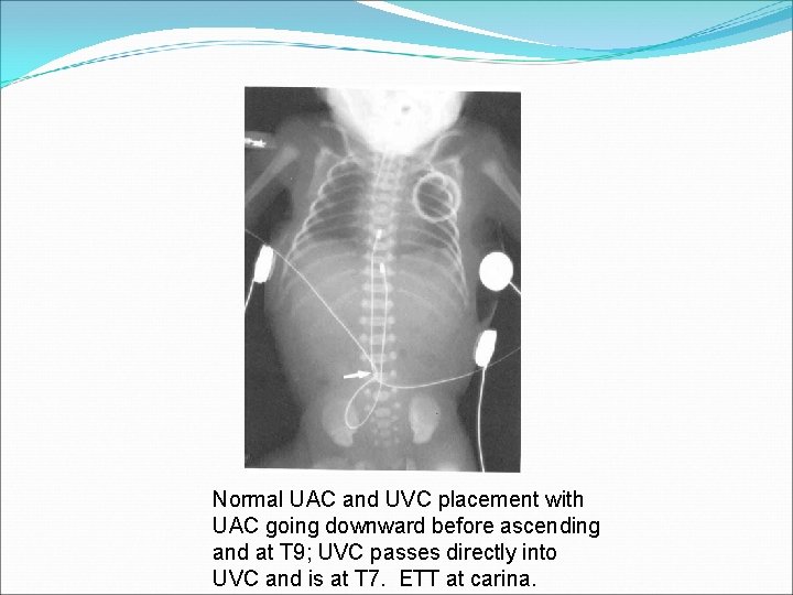 Normal UAC and UVC placement with UAC going downward before ascending and at T