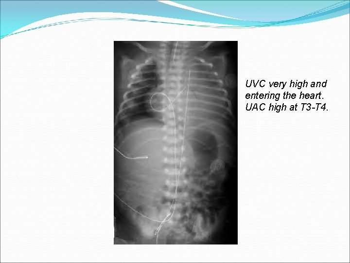 UVC very high and entering the heart. UAC high at T 3 -T 4.