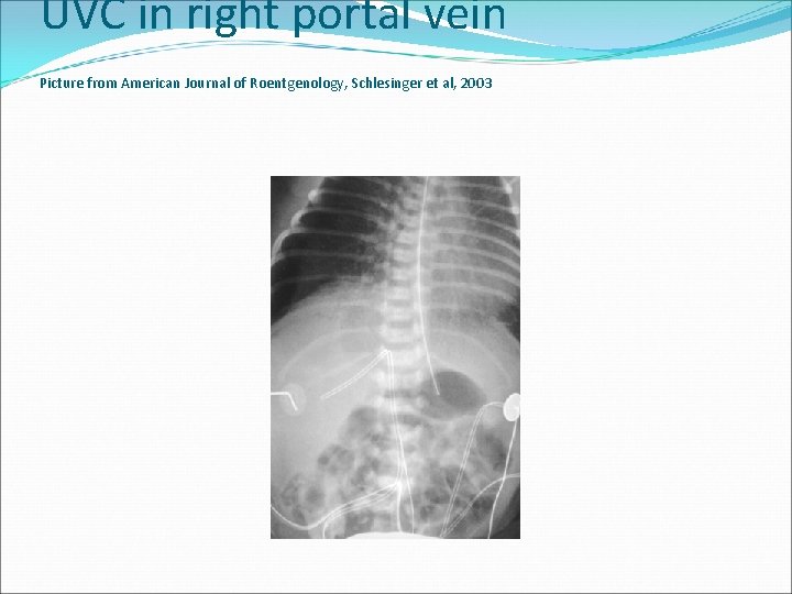 UVC in right portal vein Picture from American Journal of Roentgenology, Schlesinger et al,