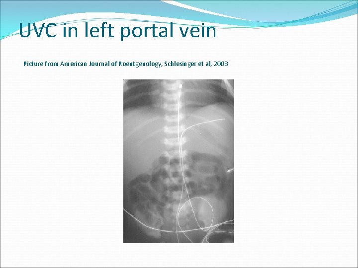 UVC in left portal vein Picture from American Journal of Roentgenology, Schlesinger et al,