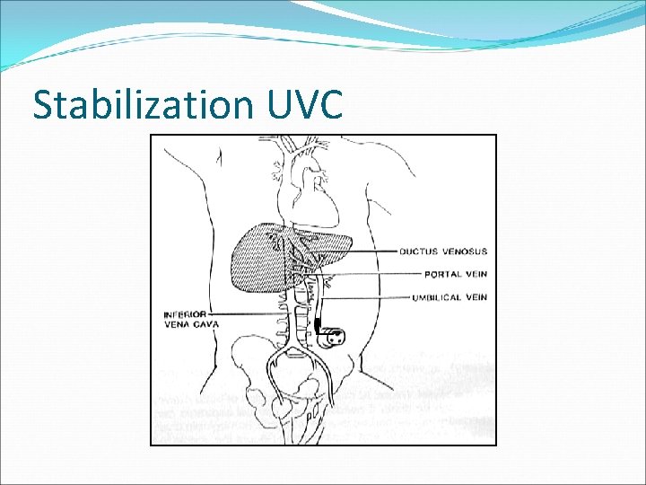 Stabilization UVC 