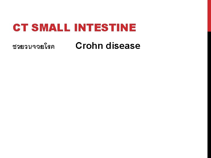 CT SMALL INTESTINE ชวยวนจฉยโรค Crohn disease 