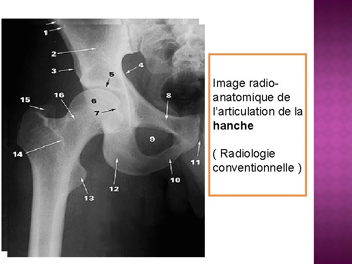 Image radioanatomique de l’articulation de la hanche ( Radiologie conventionnelle ) 