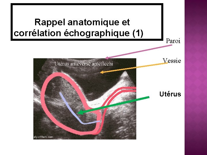 Rappel anatomique et corrélation échographique (1) Paroi Vessie Utérus 