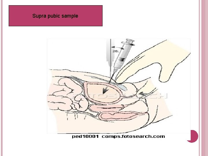 Supra pubic sample 