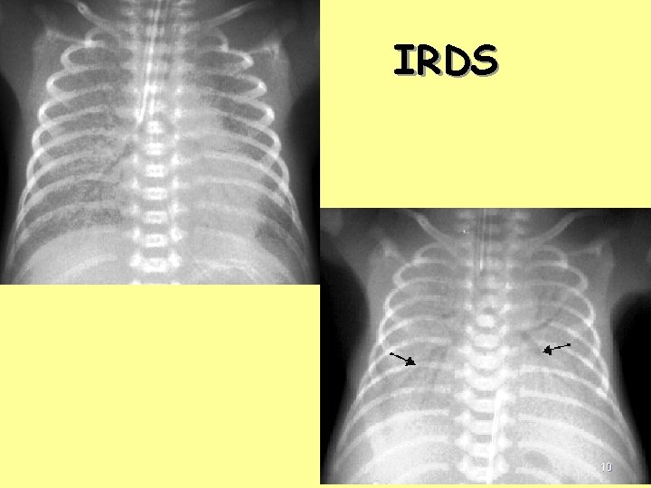 IRDS 10 