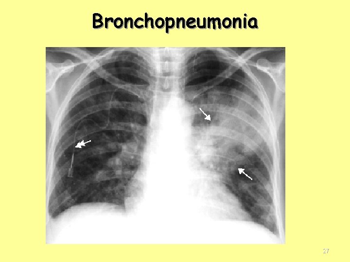 Bronchopneumonia 27 