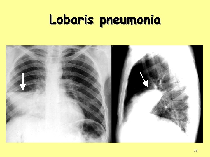 Lobaris pneumonia 28 