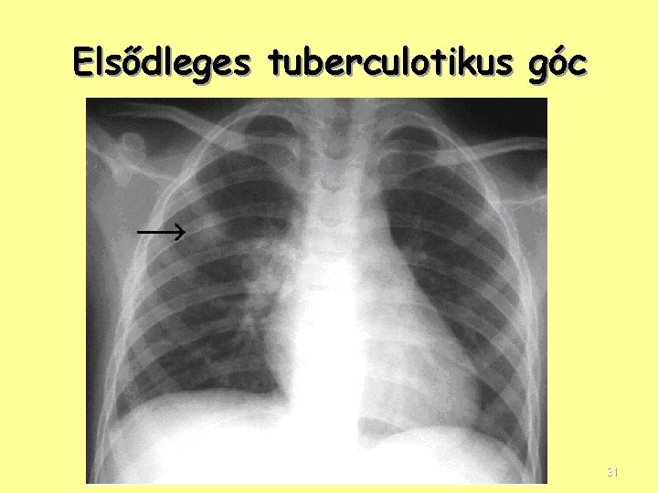 Elsődleges tuberculotikus góc 31 