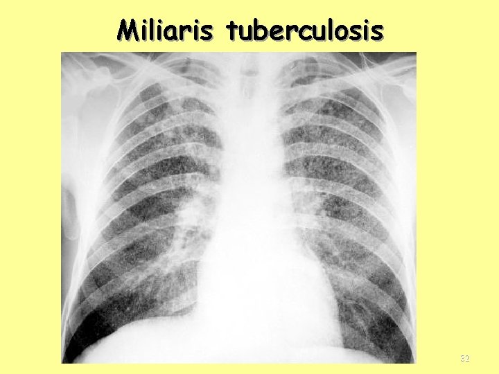 Miliaris tuberculosis 32 