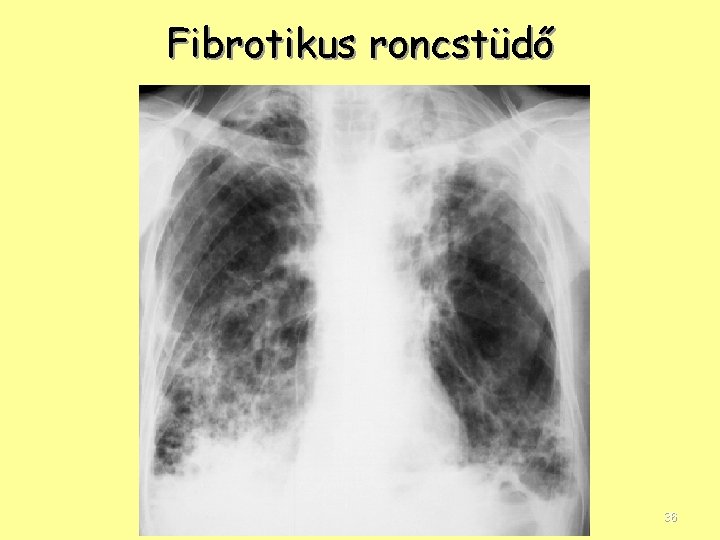 Fibrotikus roncstüdő 36 