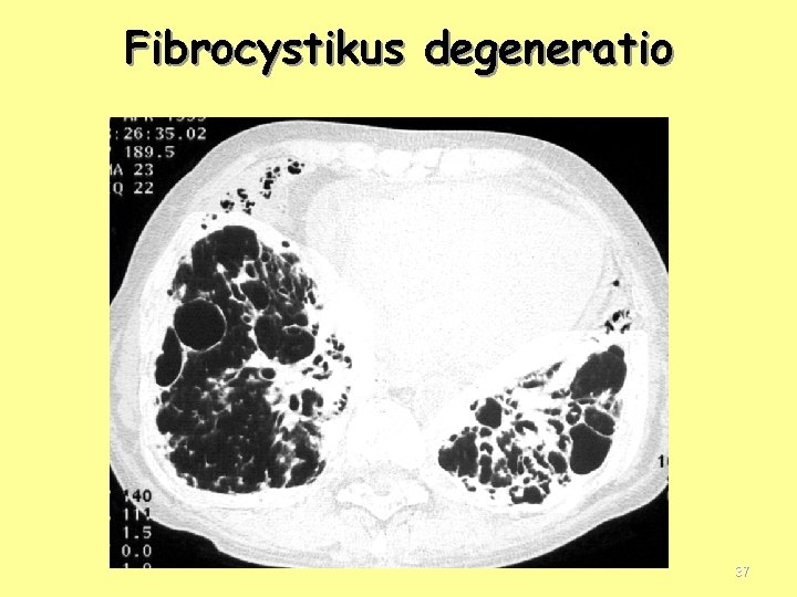 Fibrocystikus degeneratio 37 