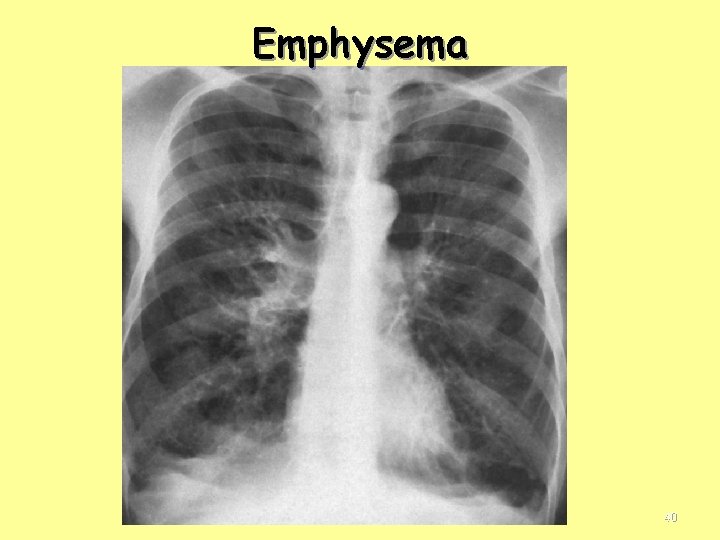 Emphysema 40 