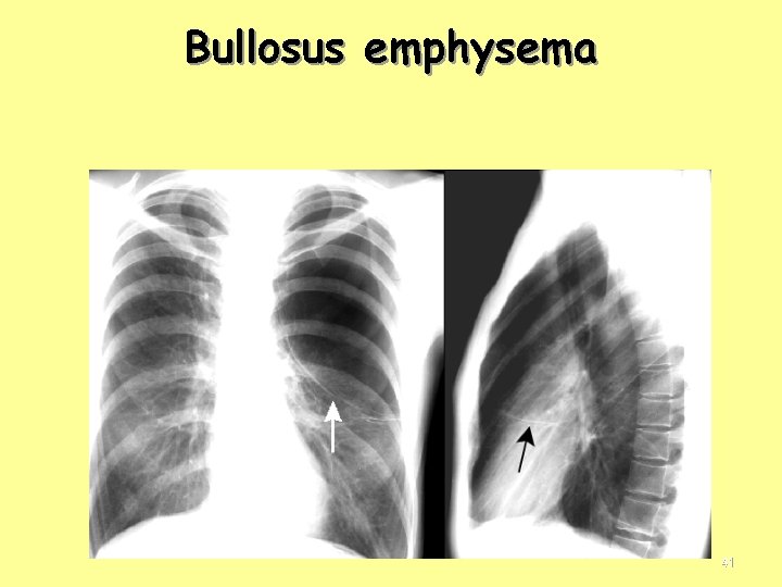 Bullosus emphysema 41 