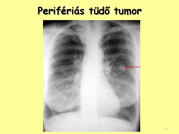 Perifériás tüdő tumor 44 