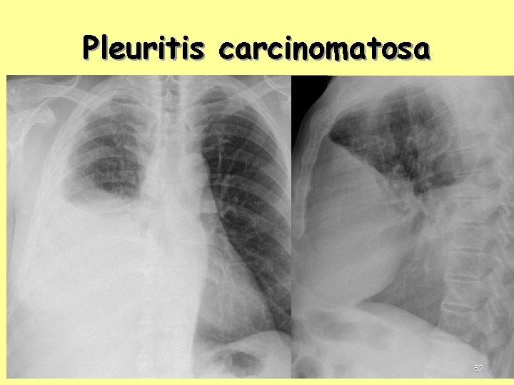 Pleuritis carcinomatosa 53 