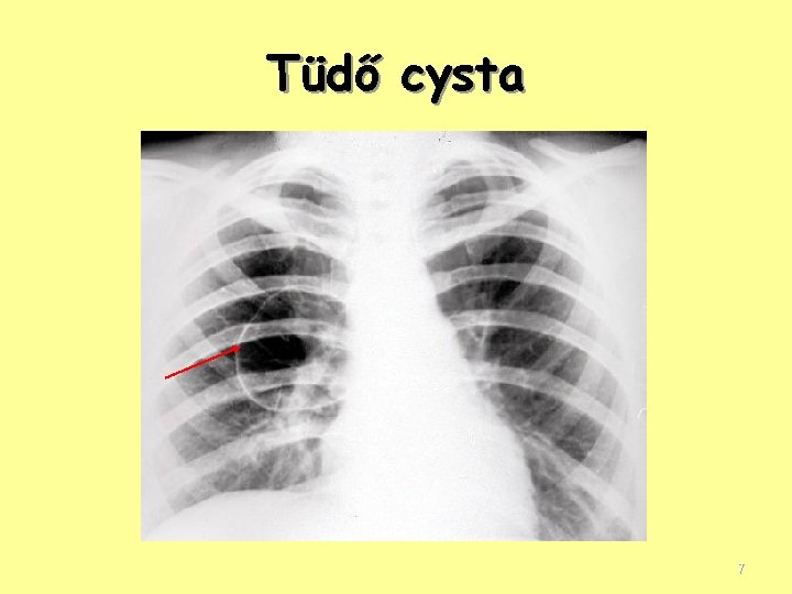 Tüdő cysta 7 