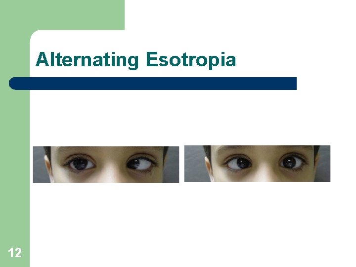 Alternating Esotropia 12 