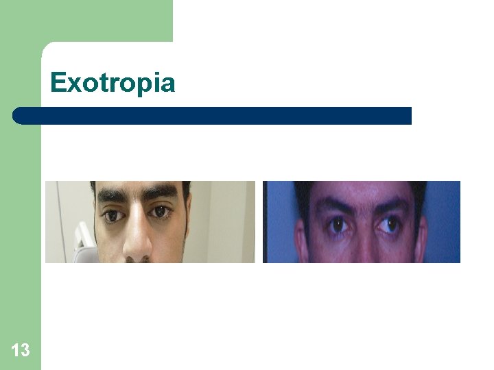 Exotropia 13 