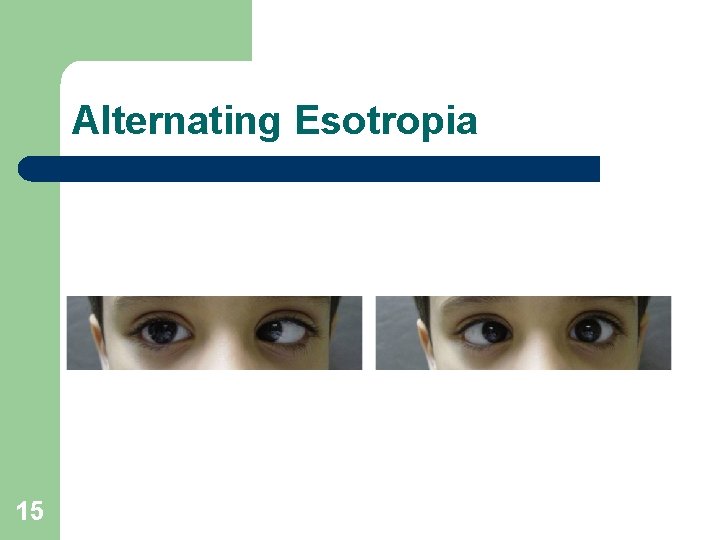 Alternating Esotropia 15 