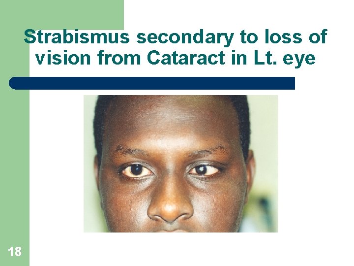 Strabismus secondary to loss of vision from Cataract in Lt. eye 18 