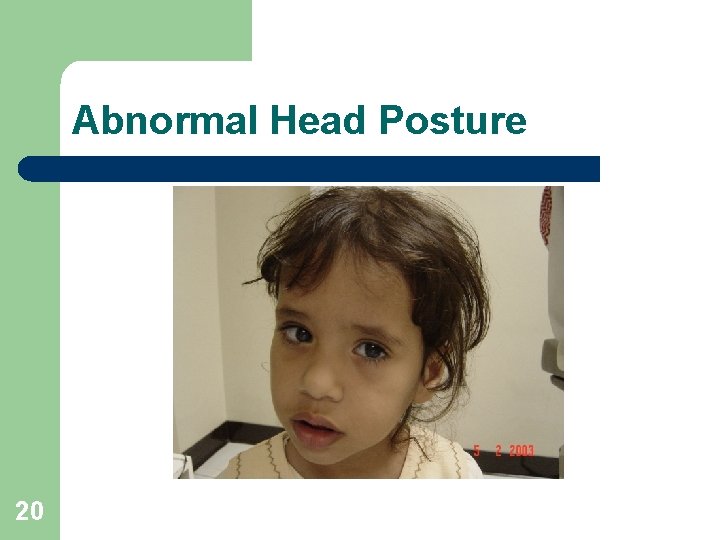 Abnormal Head Posture 20 