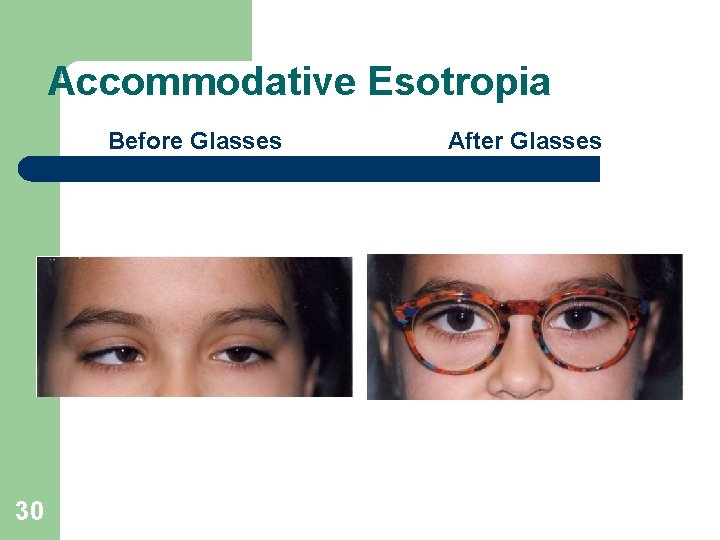 Accommodative Esotropia Before Glasses 30 After Glasses 