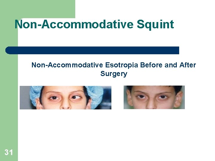 Non-Accommodative Squint Non-Accommodative Esotropia Before and After Surgery 31 