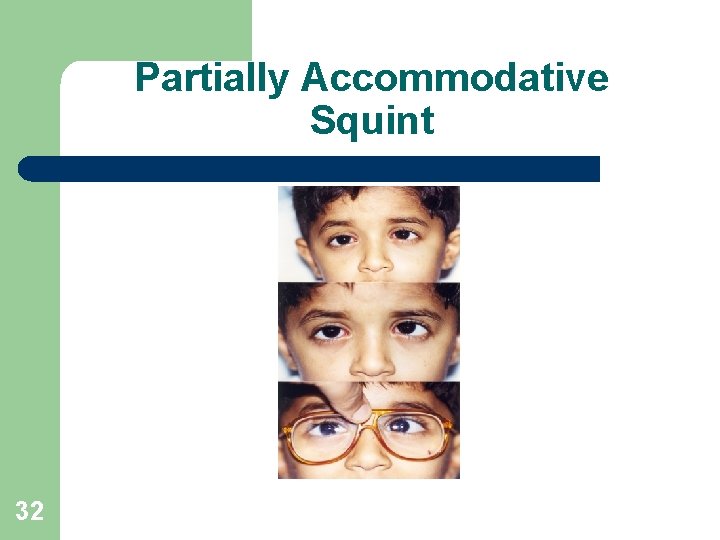 Partially Accommodative Squint 32 