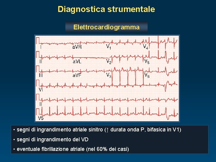 Diagnostica strumentale Elettrocardiogramma • segni di ingrandimento atriale sinitro (↑ durata onda P, bifasica