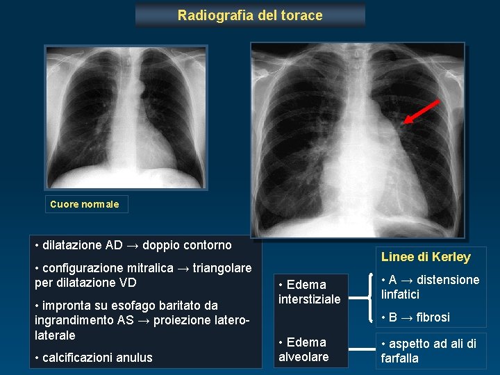 Radiografia del torace Cuore normale • dilatazione AD → doppio contorno • configurazione mitralica