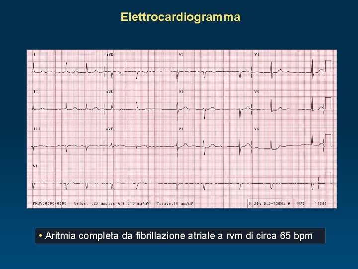 Elettrocardiogramma • Aritmia completa da fibrillazione atriale a rvm di circa 65 bpm 