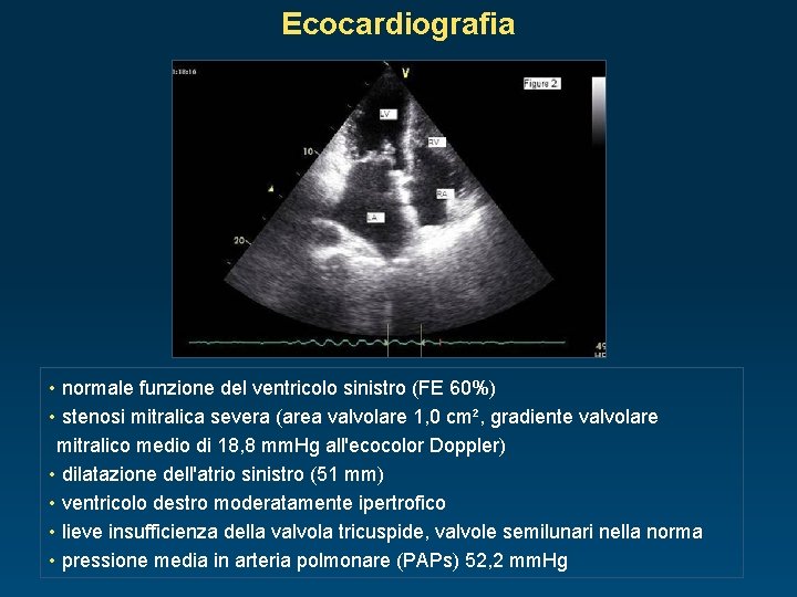 Ecocardiografia • normale funzione del ventricolo sinistro (FE 60%) • stenosi mitralica severa (area