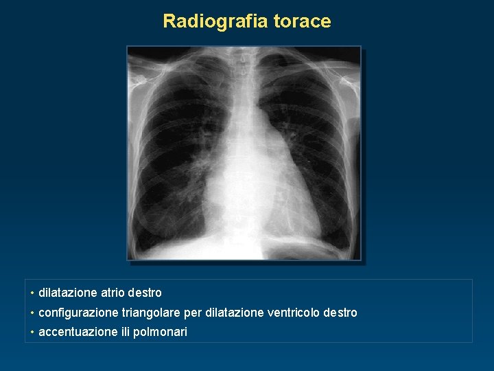 Radiografia torace • dilatazione atrio destro • configurazione triangolare per dilatazione ventricolo destro •