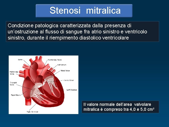 Stenosi mitralica Condizione patologica caratterizzata dalla presenza di un’ostruzione al flusso di sangue fra