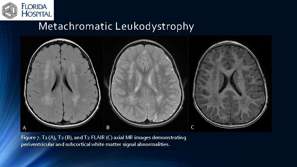 Metachromatic Leukodystrophy A B Figure 7. T 1 (A), T 2 (B), and T