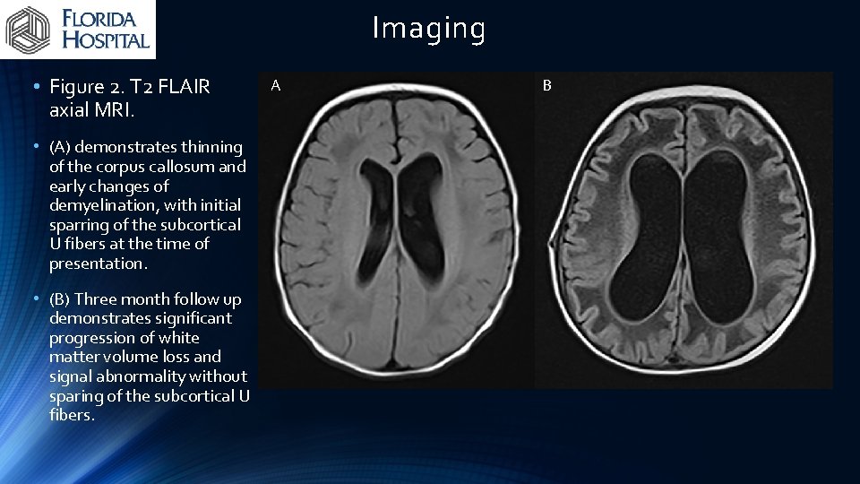 Imaging • Figure 2. T 2 FLAIR axial MRI. • (A) demonstrates thinning of