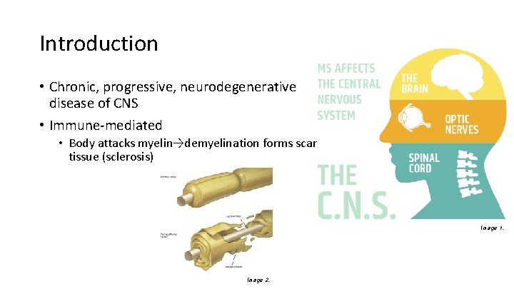 Introduction • Chronic, progressive, neurodegenerative disease of CNS • Immune-mediated • Body attacks myelin→demyelination