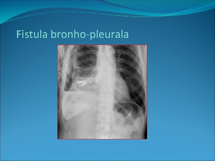Fistula bronho-pleurala 