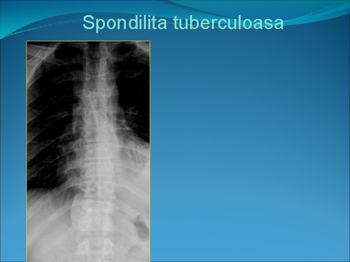 Spondilita tuberculoasa 